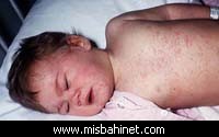 parentmeasles